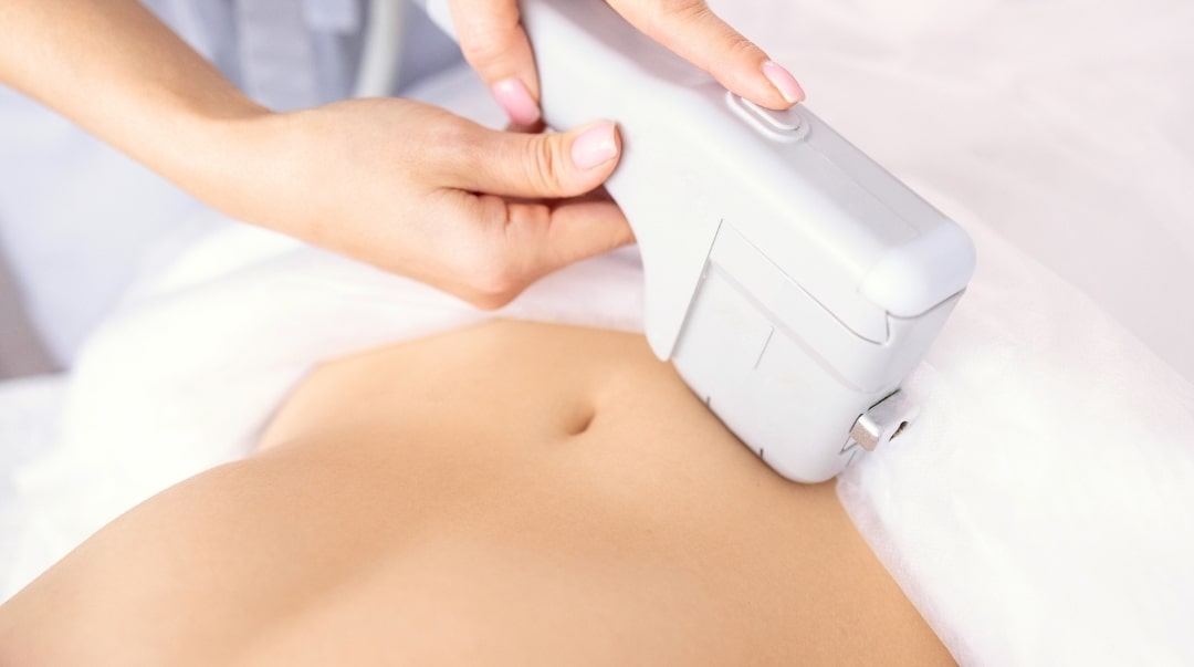 hifu treatment done on patient belly