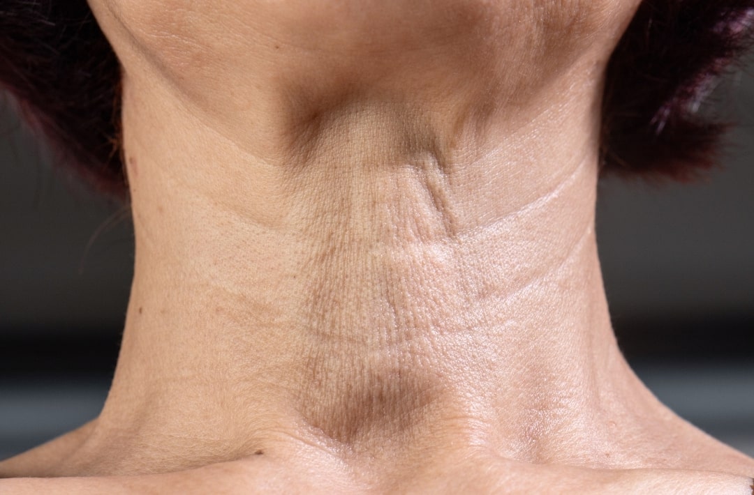 wrinkles on woman neck