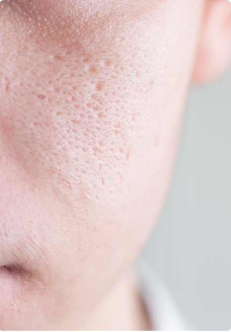 enlarged pores on cheeks