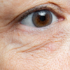 Fine lines under eyes