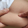 elacticity on arm