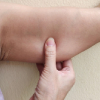 loose skin on arm