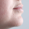 mild skin dehydration