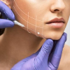 thred lift on jaw