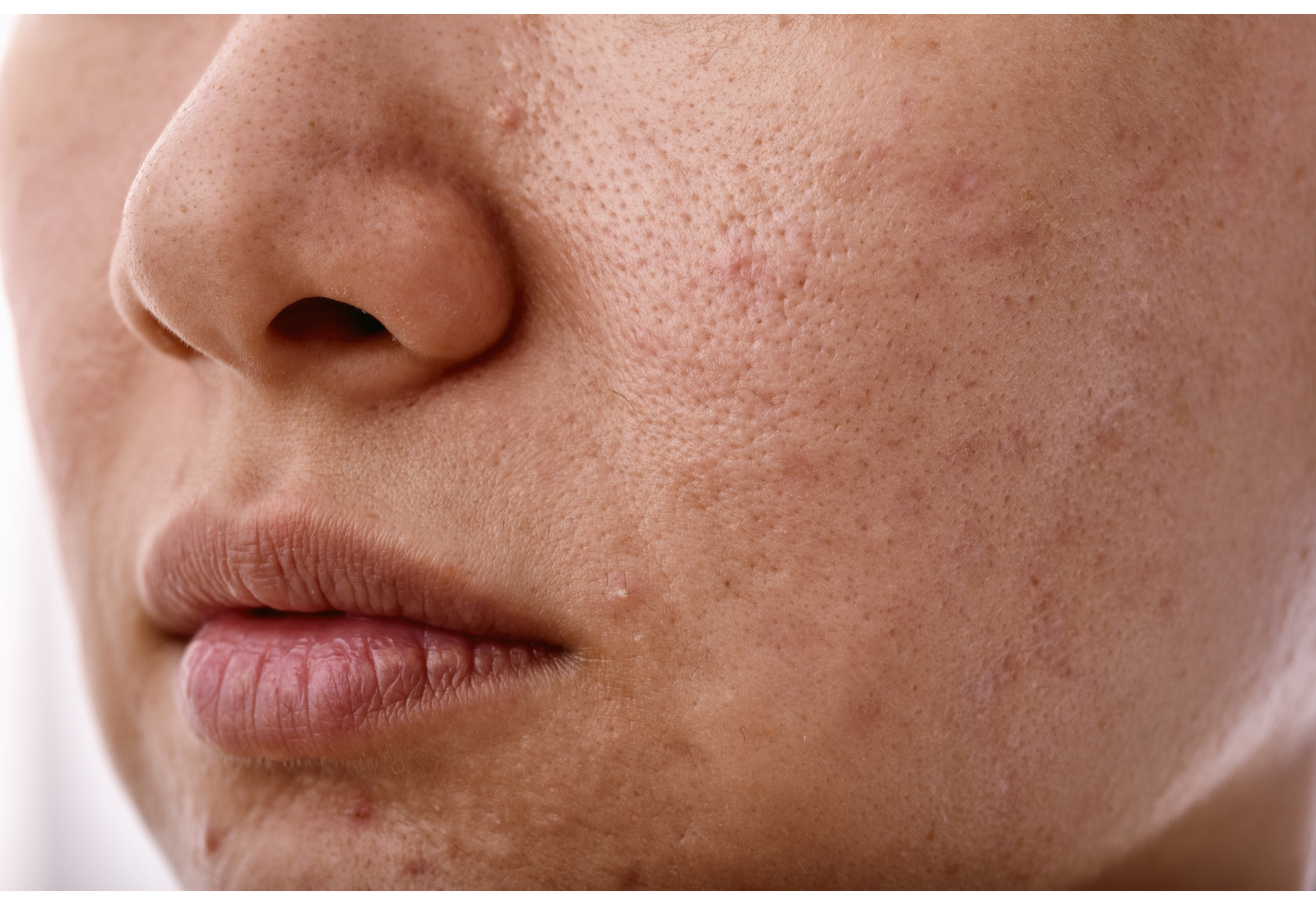 uneven skin tone