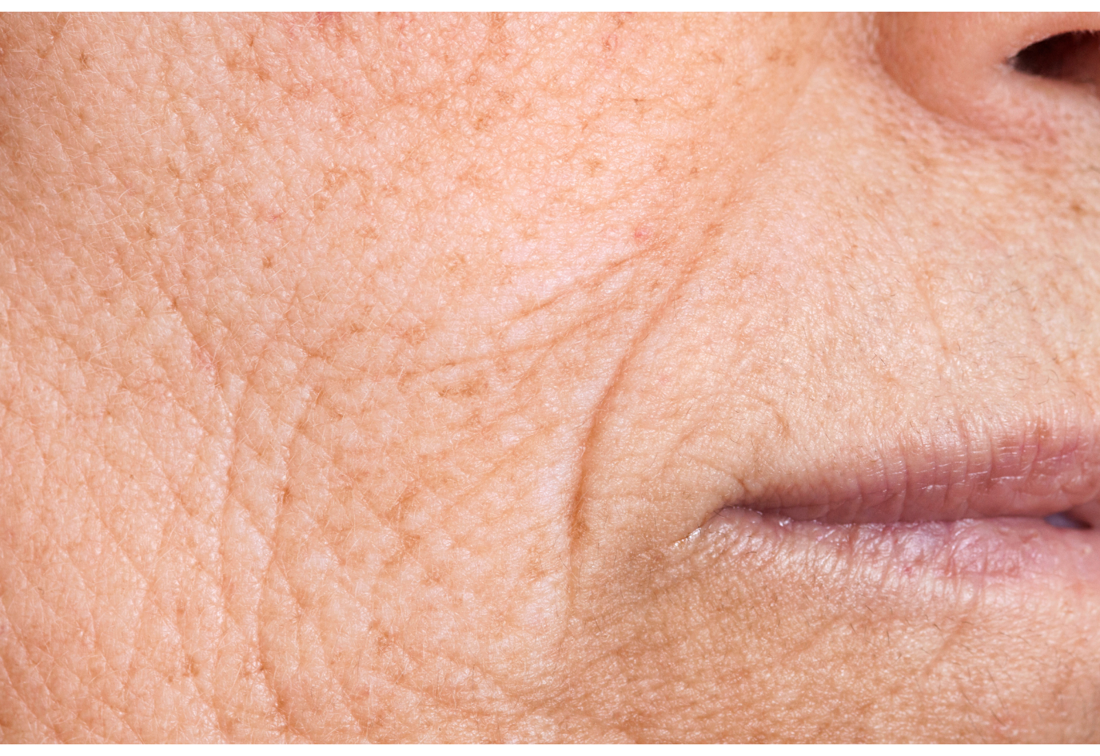 wrinkled skin on cheeks