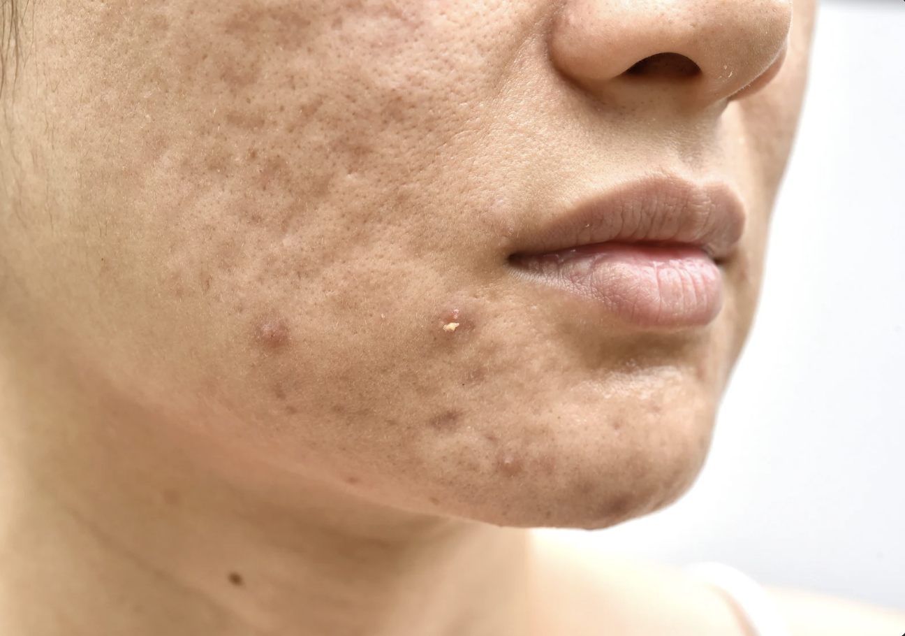 Screenshot 2025-10-30 at 7.54.09 AM acne scar