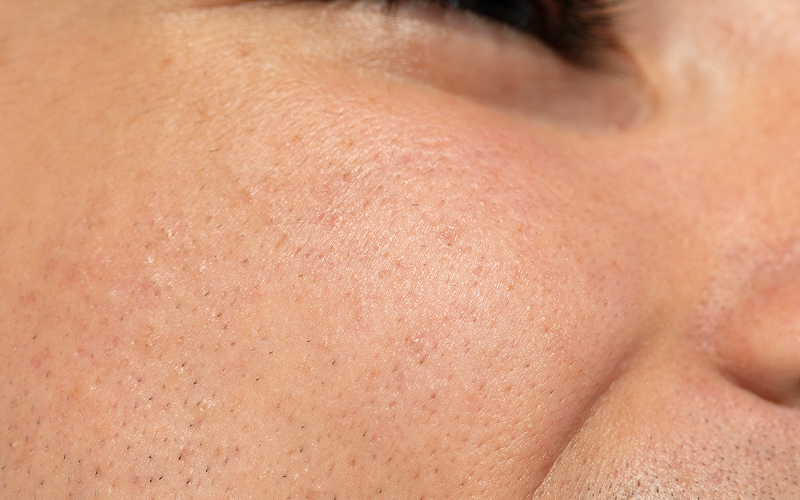 Macro view of skin texture and pores on the cheek.