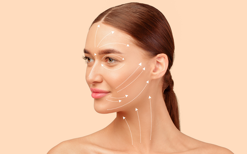 Clinical facial markings for a non-surgical face lift procedure.