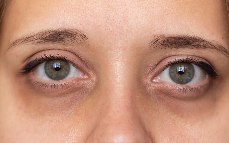 Close-up of hollow under-eyes showing early facial volume loss.