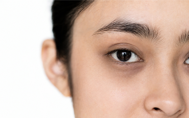Close-up-of-woman's-eyes-showing-under-eye-dark-circles