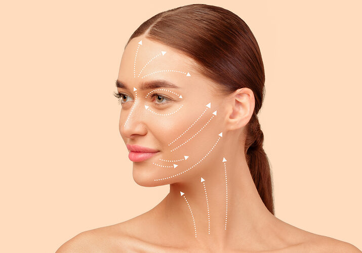 Clinical facial markings for a non-surgical face lift procedure.