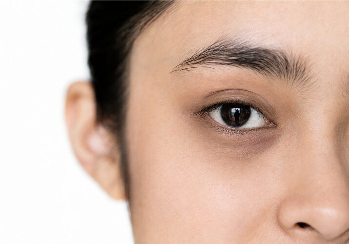 Close-up-of-woman's-eyes-showing-under-eye-dark-circles