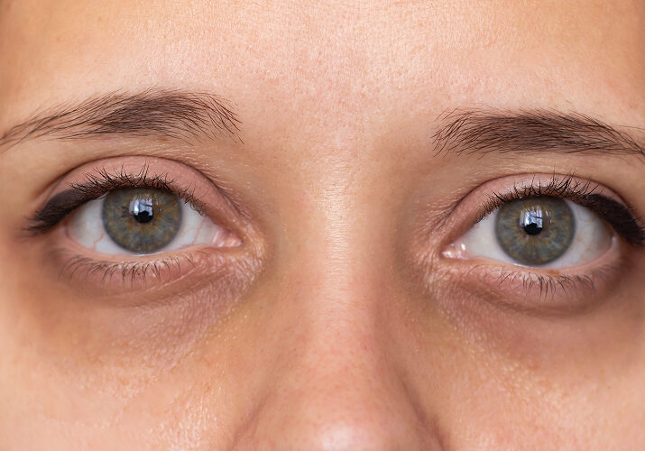 Close-up of hollow under-eyes showing early facial volume loss.