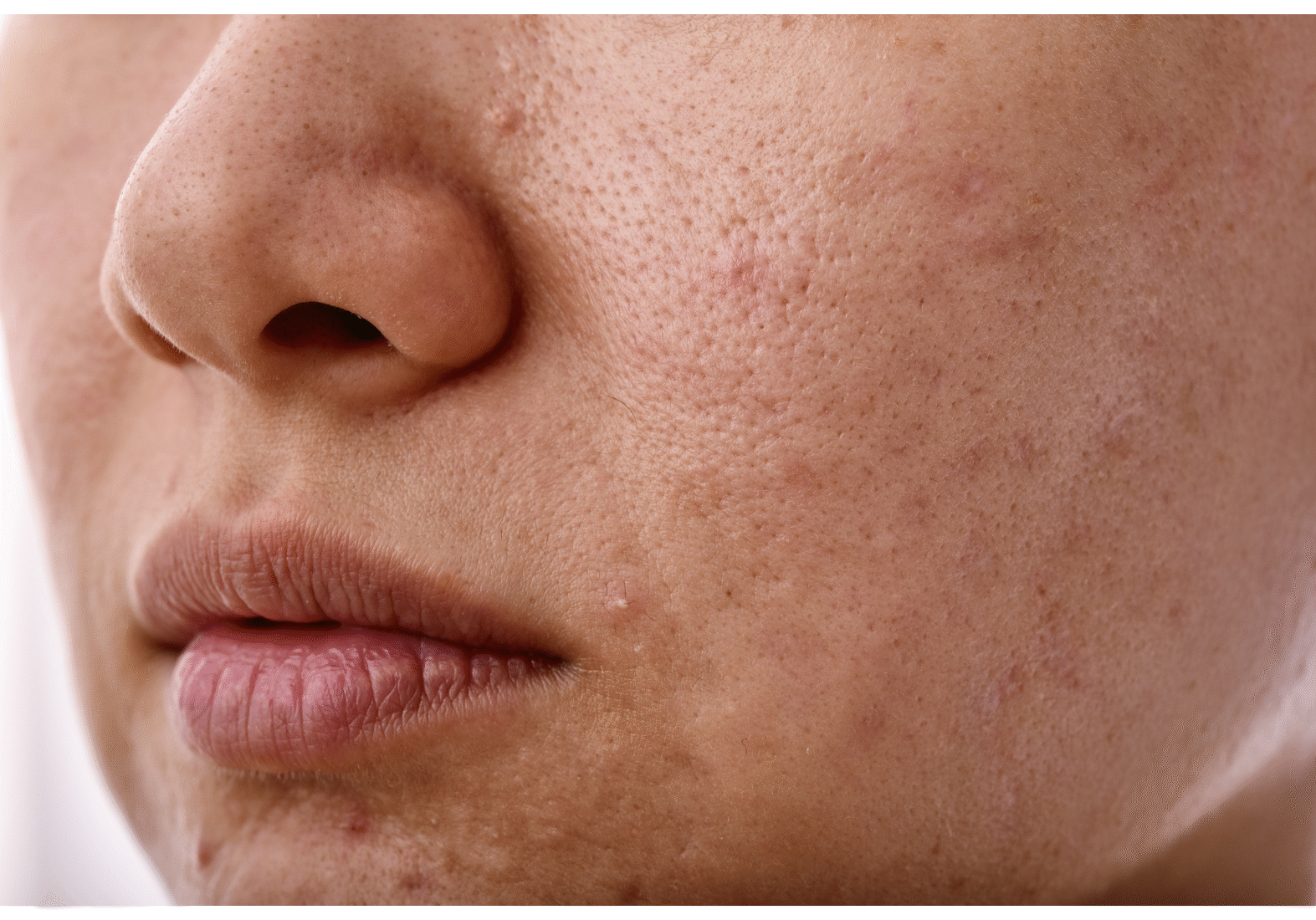 uneven skin tone